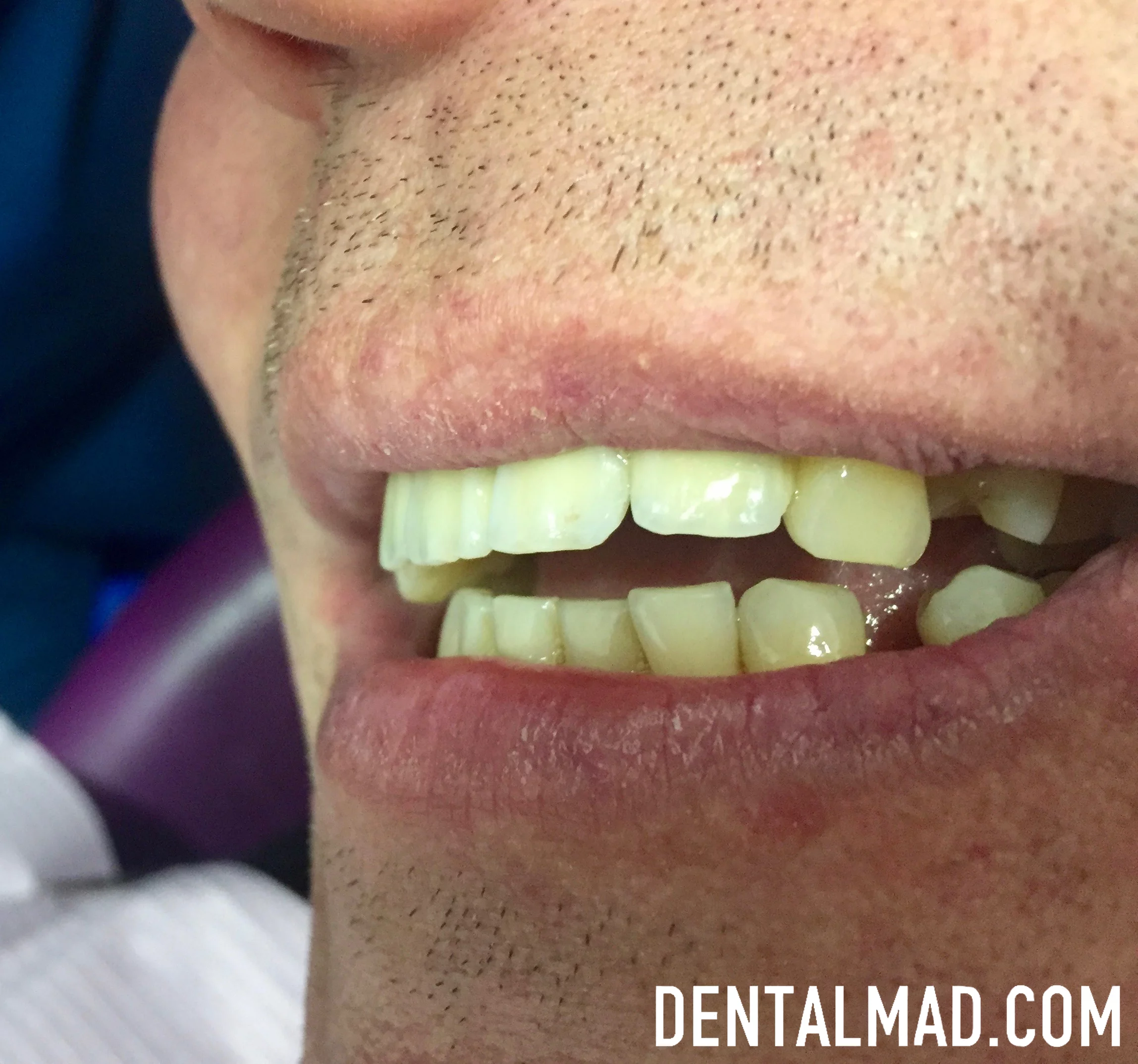 Implantes Dentales En Madrid | Implantes Dentales | 【DENTALMAD】